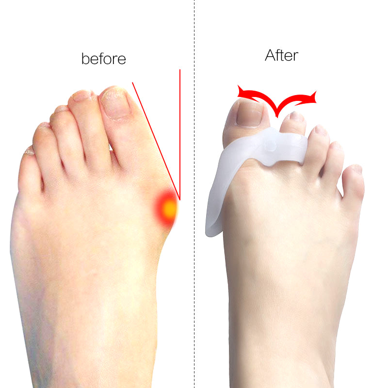 SILICONE BUNION CORRECTOR